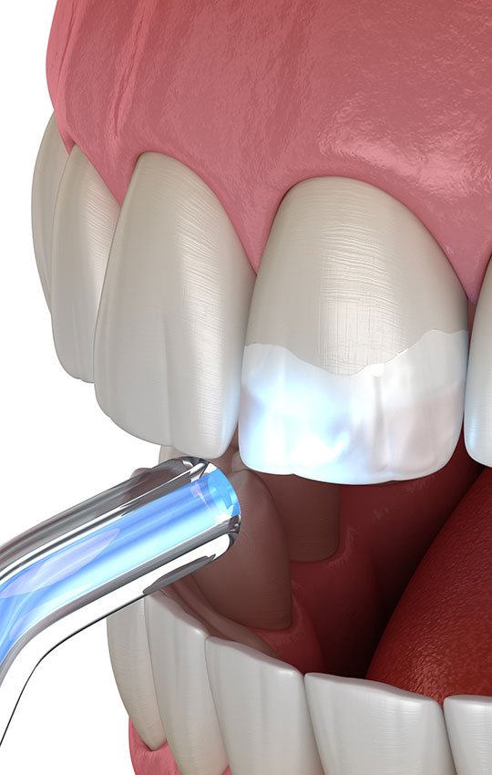 Conservative-dentistry-ft