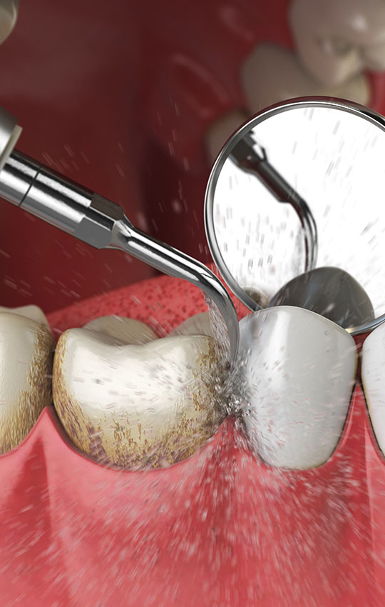 Periodontal-Treatment-ft