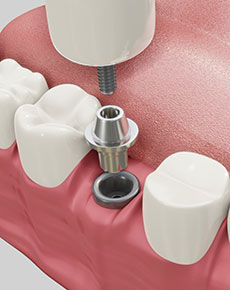 test-Implants