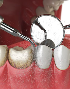 test-Periodontal-Treatment
