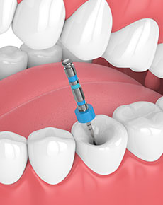 test-Root-Canal