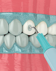 test-Tooth-Whitening