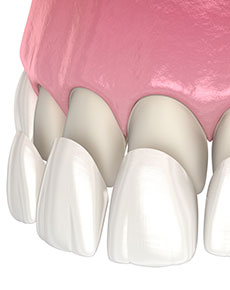 test-Veneers