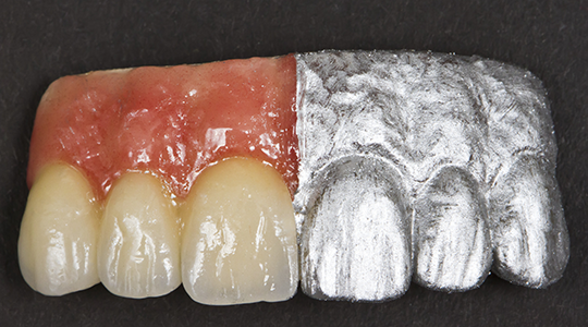 Dental-Crown-2
