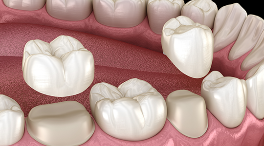 Dental-Crown-3