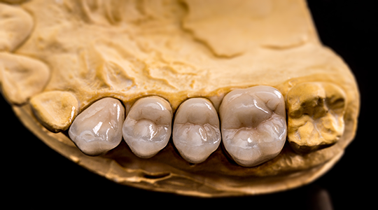 Dental-Crown-4