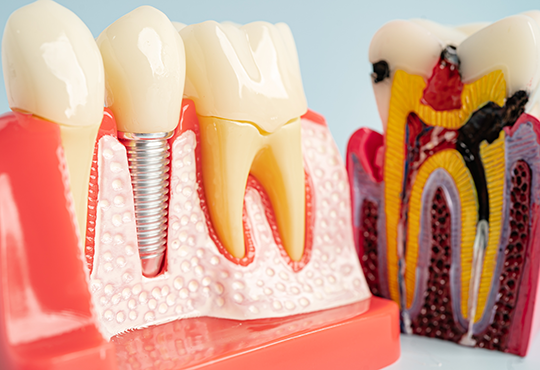 Dental-Implant-1