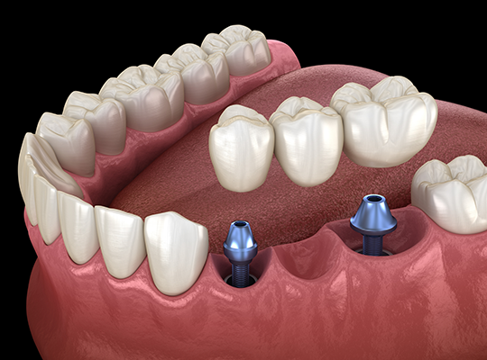 Dental-Implant-2