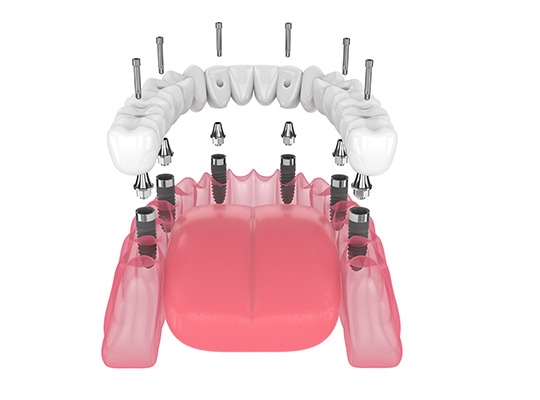 Dental-Implant-3