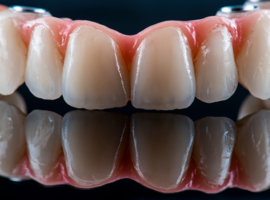 Dental-Implant-4