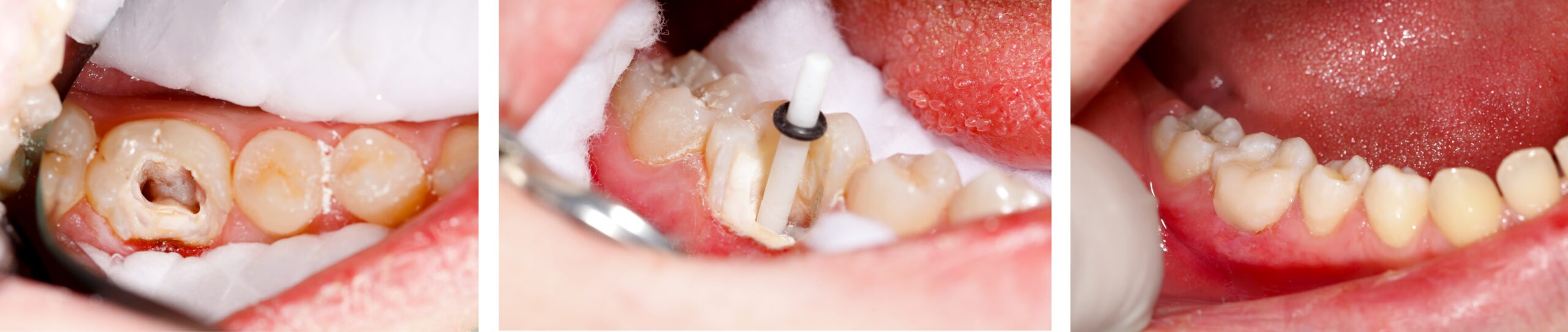 Root Canal 1