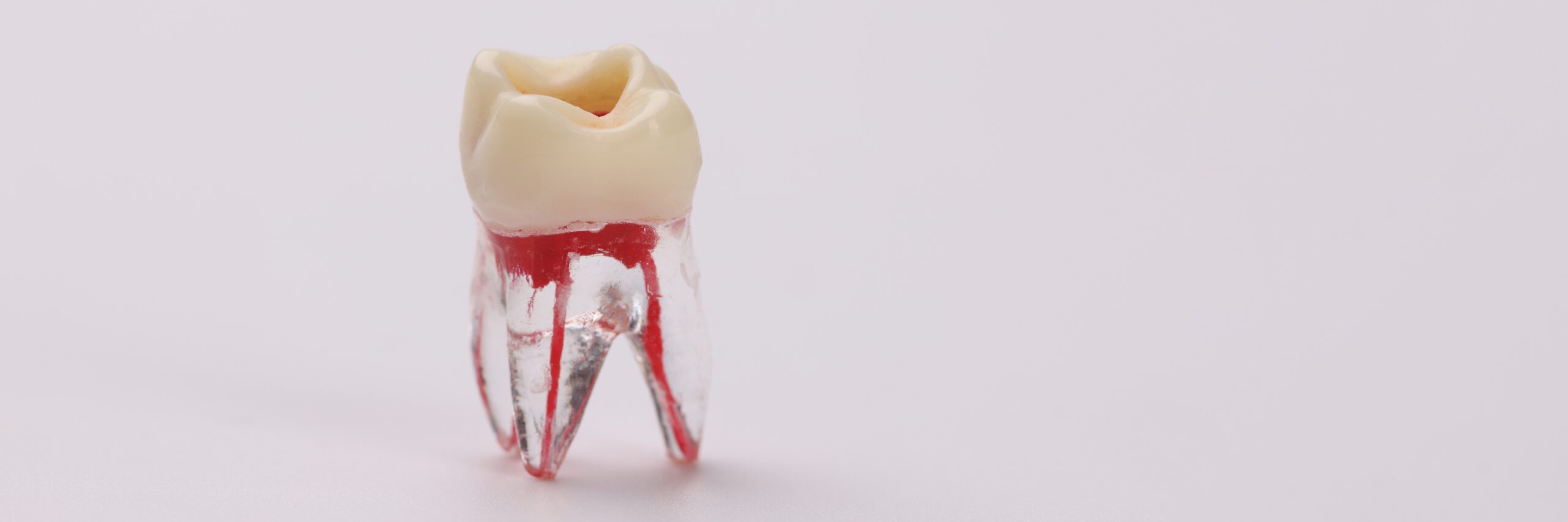 Root Canal 2